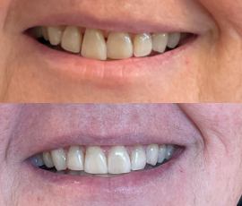 Invisalign