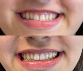 Invisalign Treatment