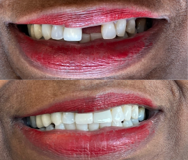 Dental Implant