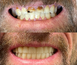 Teeth in a Day