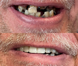 Teeth in a Day