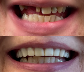 Upper Snap On Denture