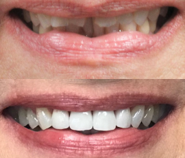 Veneers