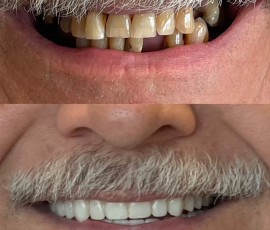 Teeth in a Day