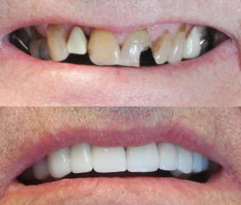 Teeth in a Day