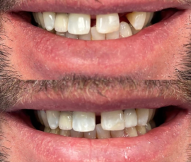 Single Implant