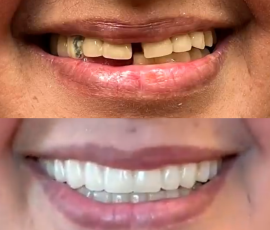 Teeth in a Day