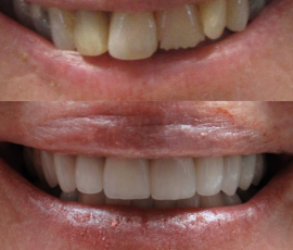 10 Upper and 10 Lower Ceramic Veneers