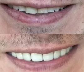 Veneers