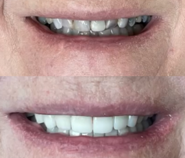 Veneers