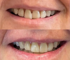 Invisalign