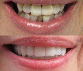 Crowns & Veneers