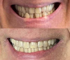 Invisalign