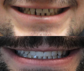 Invisalign & Whitening
