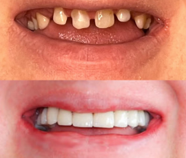 Implants & Crowns