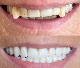Teeth in a Day
