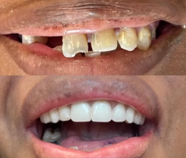 Teeth in a Day