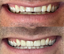 Veneers