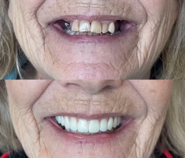 Teeth in a Day