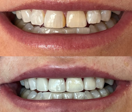 Veneers