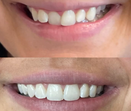Invisalign