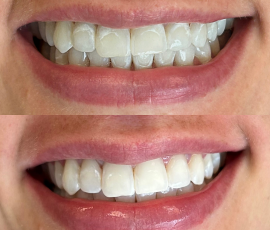 ICON Spot Whitening Treatment