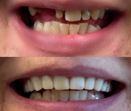 Upper Snap On Denture