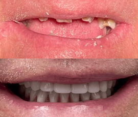 Snap on Dentures