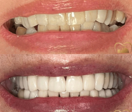 Crowns & Veneers