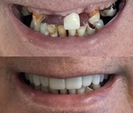 Teeth in a Day