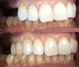 Implants & Ceramic Crowns