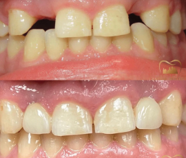 Implants & Ceramic Crowns