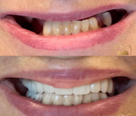 Permanent Upper Bridge with Lower Removable Partial Denture