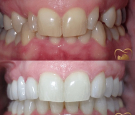 Multistage Treatment