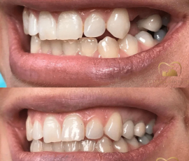 Implant