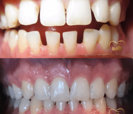 Invisalign