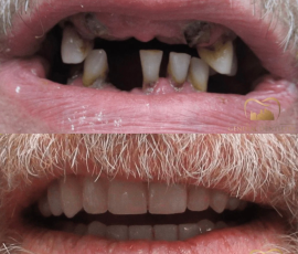 Teeth in a Day