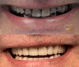 Teeth in a Day