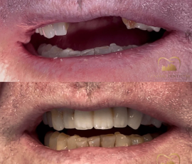 Implant Ceramic Bridge