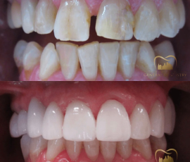 Whitening & Veneers
