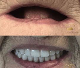 Teeth in a Day
