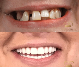 Teeth in a Day