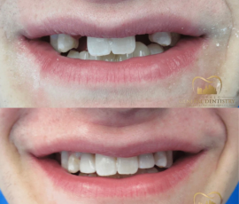 Implants & Ceramic Crowns