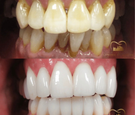 Multistage Treatment