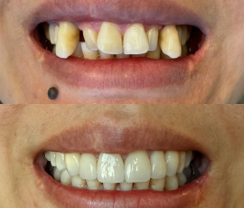 Multistage Treatment