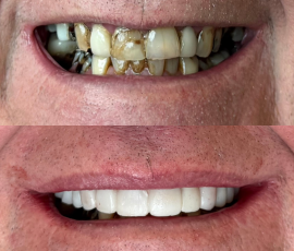 Teeth in a Day
